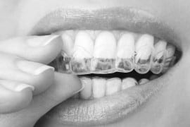 Custom Dental Trays London