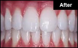 Laser Teeth Whitening in London After