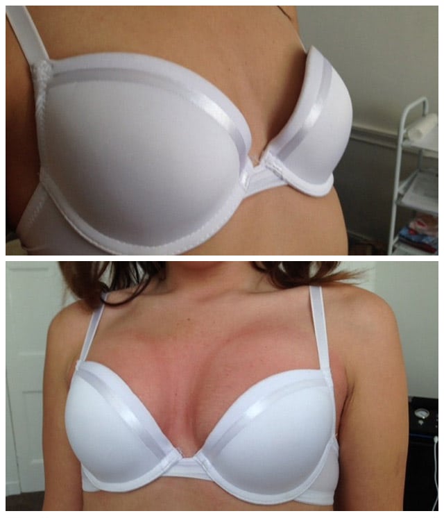 Breast Lift Treatment London Before And After