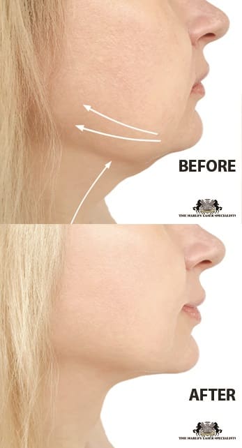 Double Chin Treatment In London