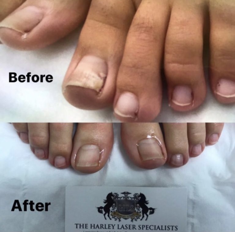 Nail Fungus Treatment Laser Nail Fungal