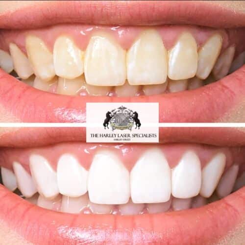 Why is teeth whitening one of the most popular cosmetic treatments? Harley Laser Specialists