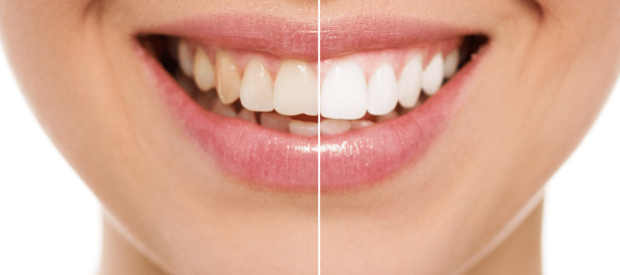 Red White Teeth Whitening Instagram Post