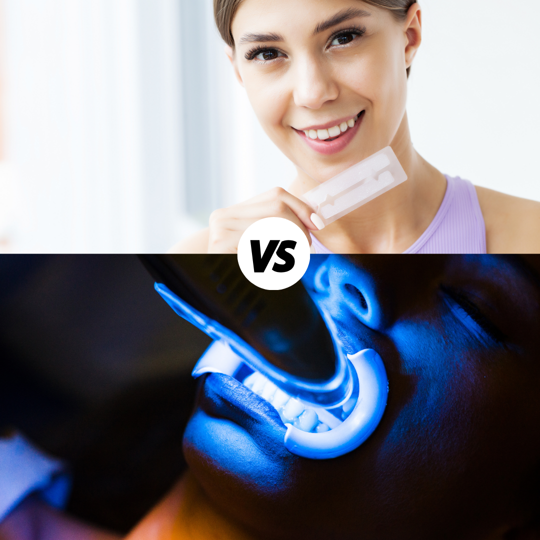 laser teeth whitening vs bleaching strips