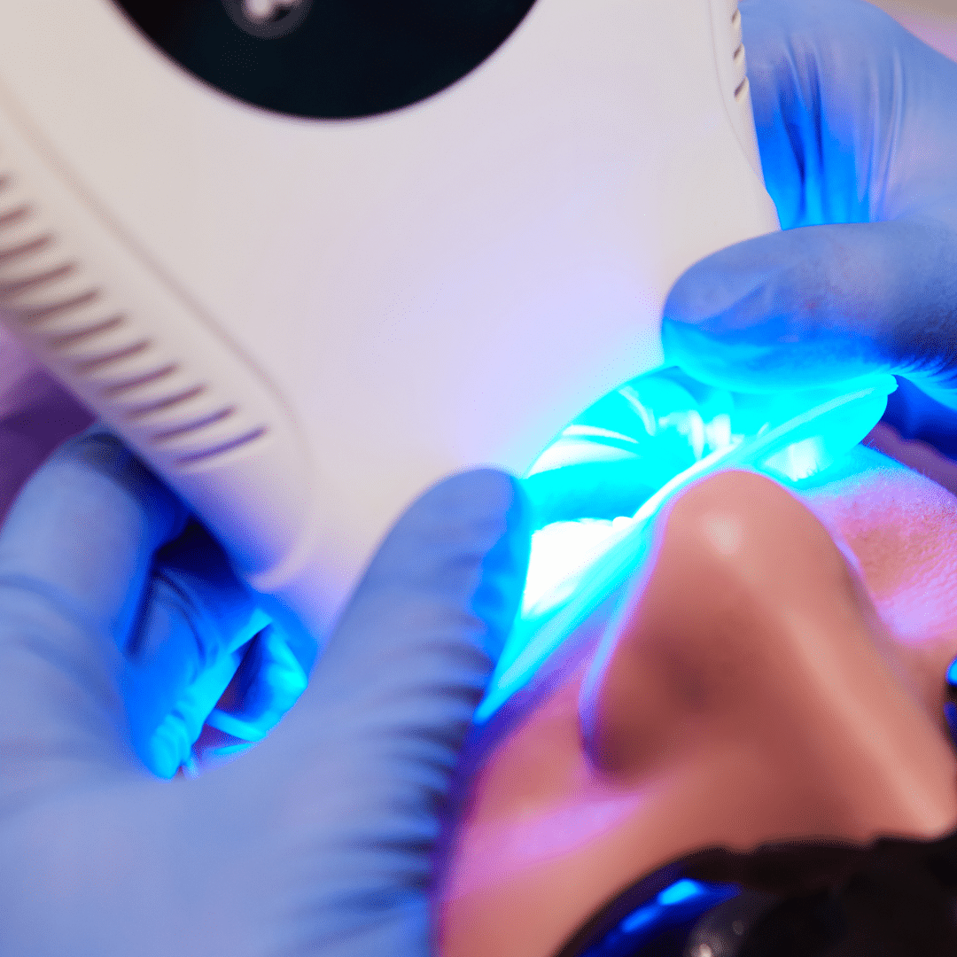 laser teeth whitening