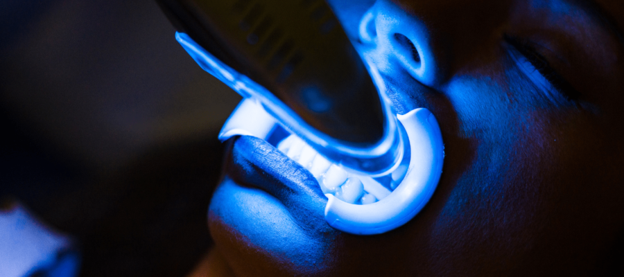 laser teeth whitening