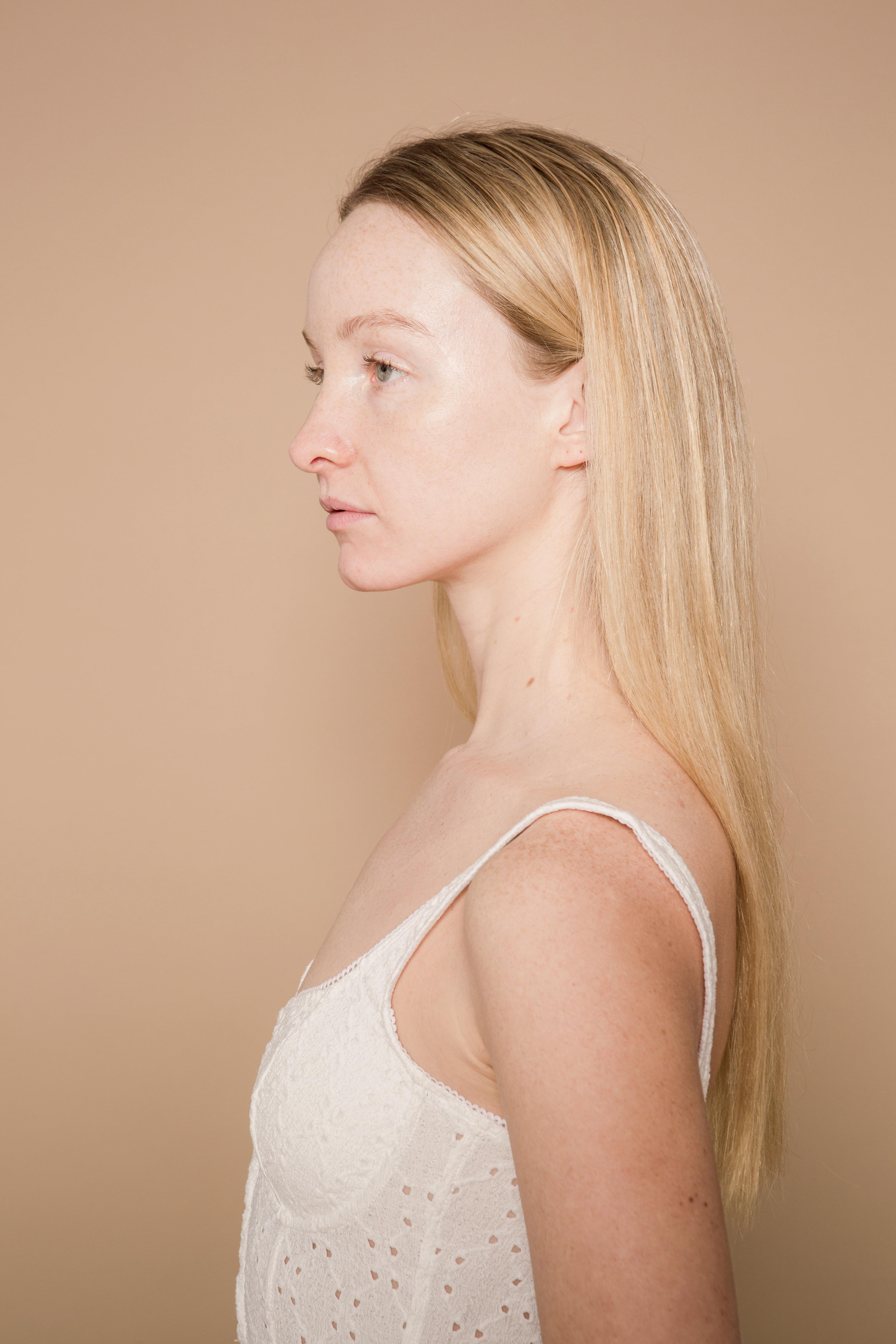 laser hair removal