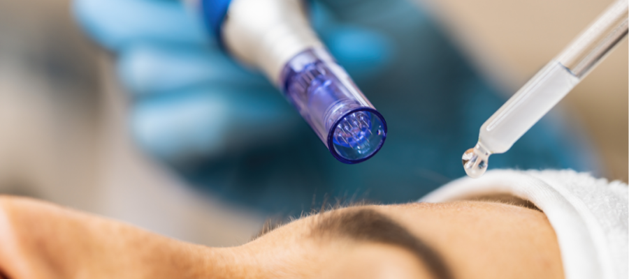 dermapen microneedling