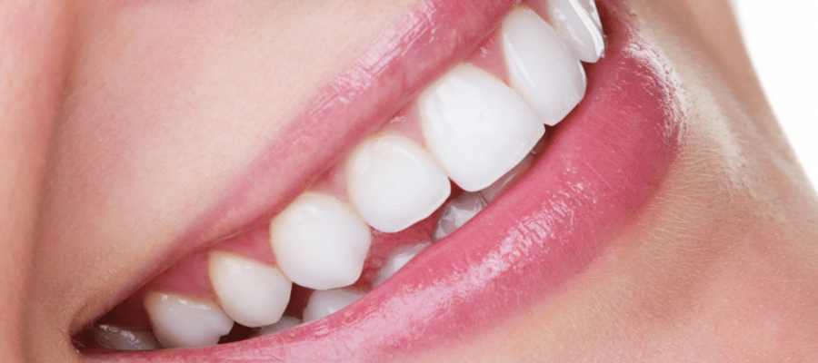 teeth whitening