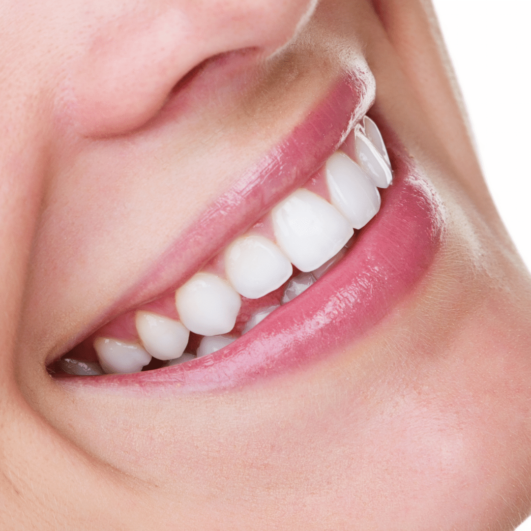 teeth whitening