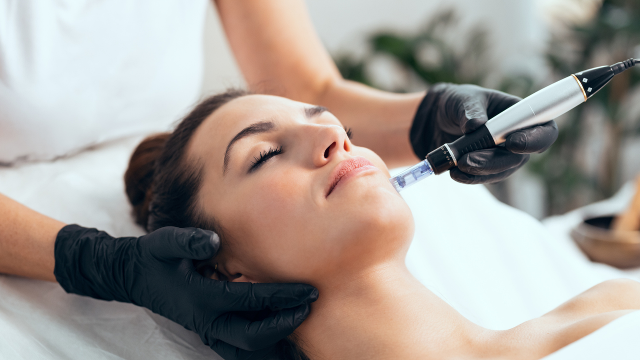 microneedling