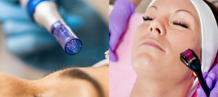 Microneedling vs. Traditional Dermarollers: Which is Better?