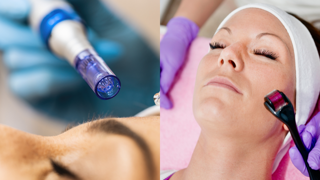 Microneedling vs. Traditional Dermarollers: Which is Better?