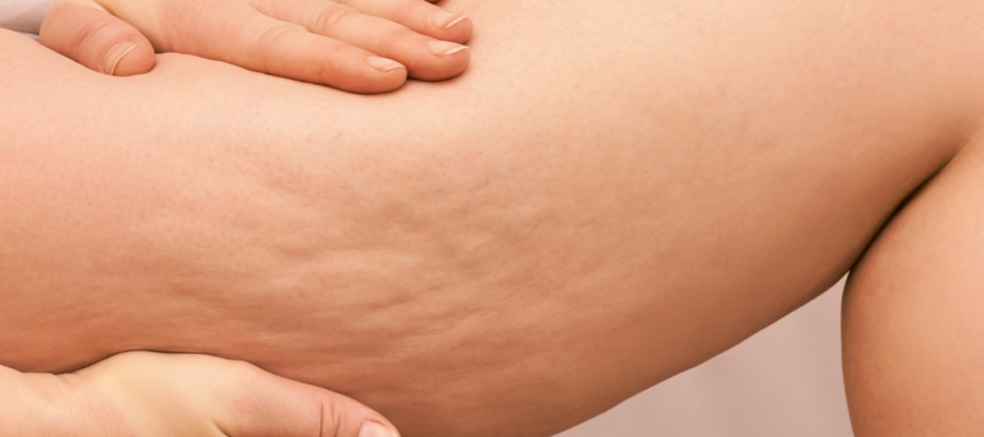 cellulite treatment