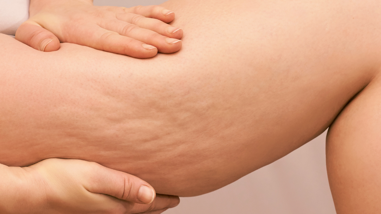 cellulite treatment