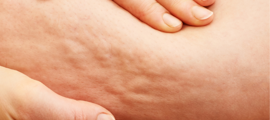 Cellulite