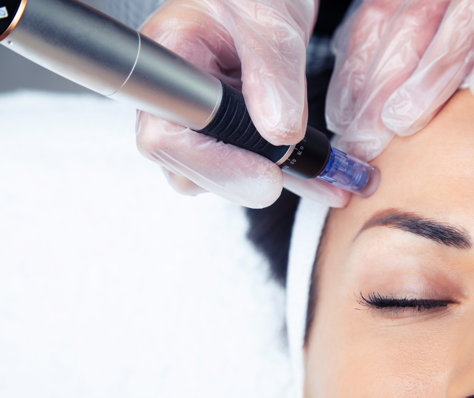Microneedling