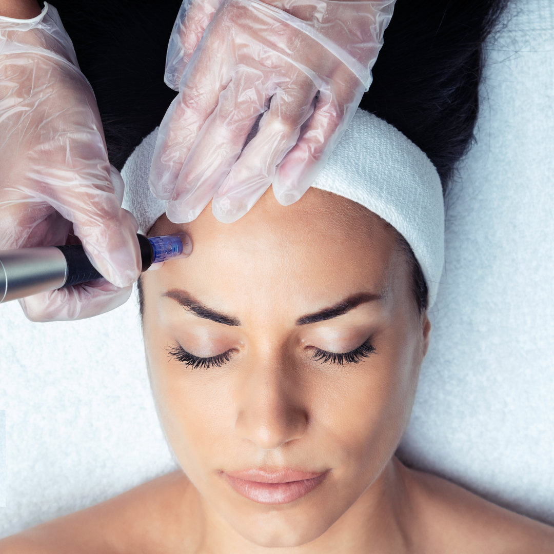 Microneedling