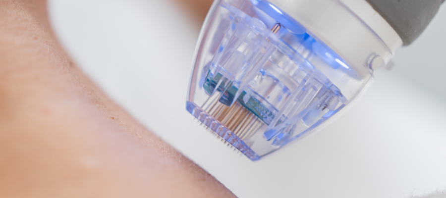Microneedling