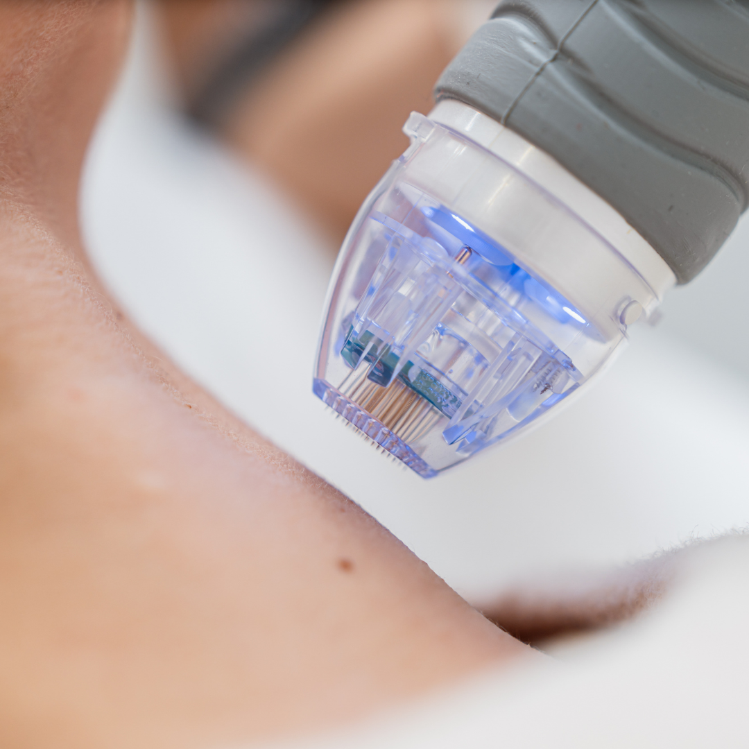 Microneedling
