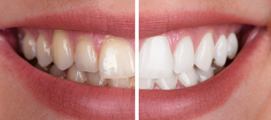 Teeth Whitening