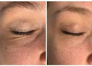 Lumi Pro Skin Booster