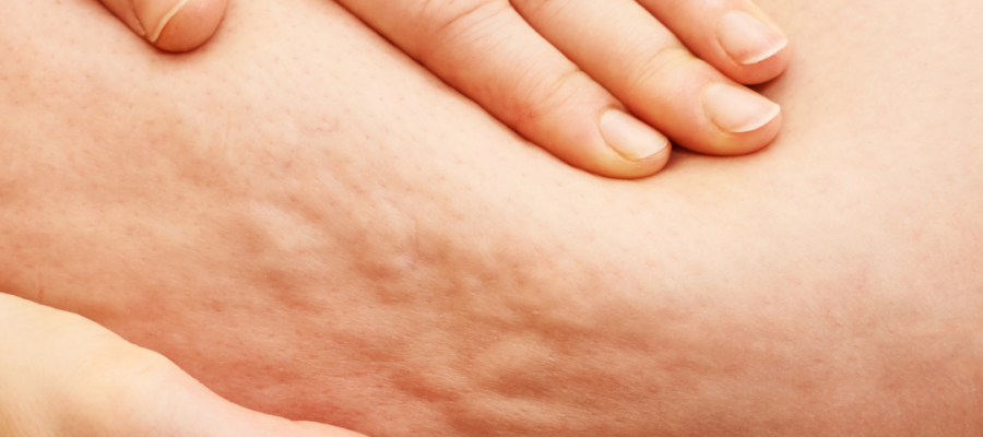Cellulite