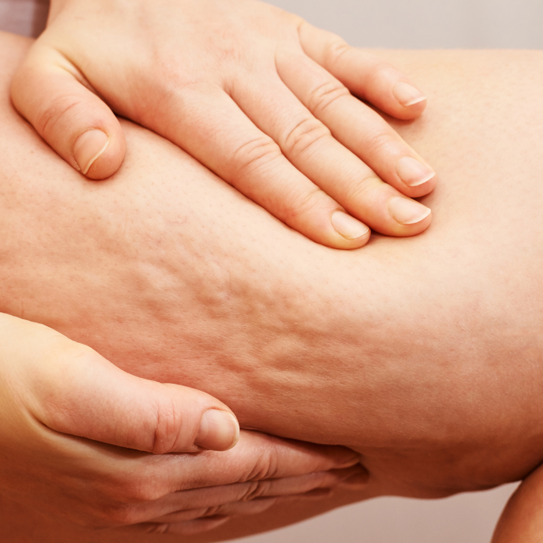 Cellulite