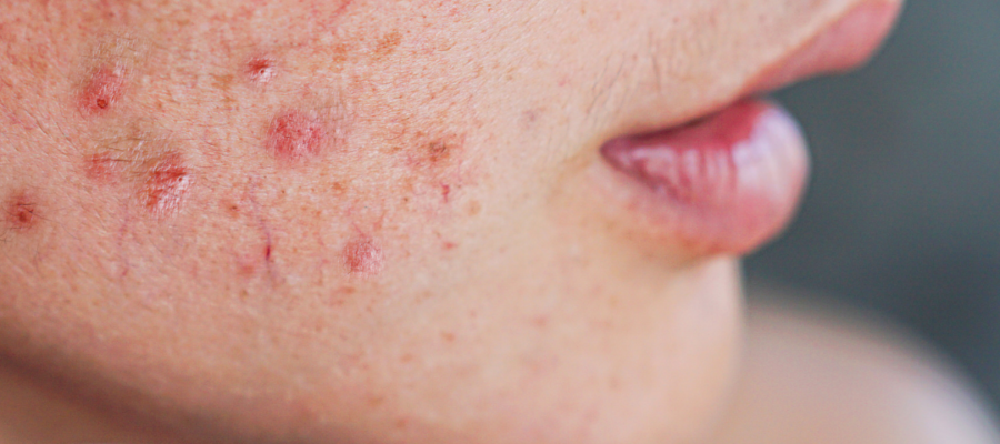 Acne