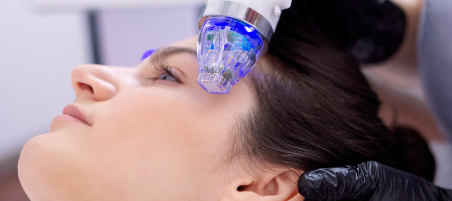 Microneedling Sessions treatment for skin rejuvenation and acne scar reduction