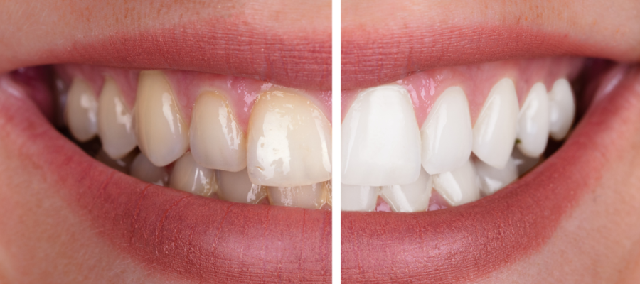 Laser Teeth Whitening Results