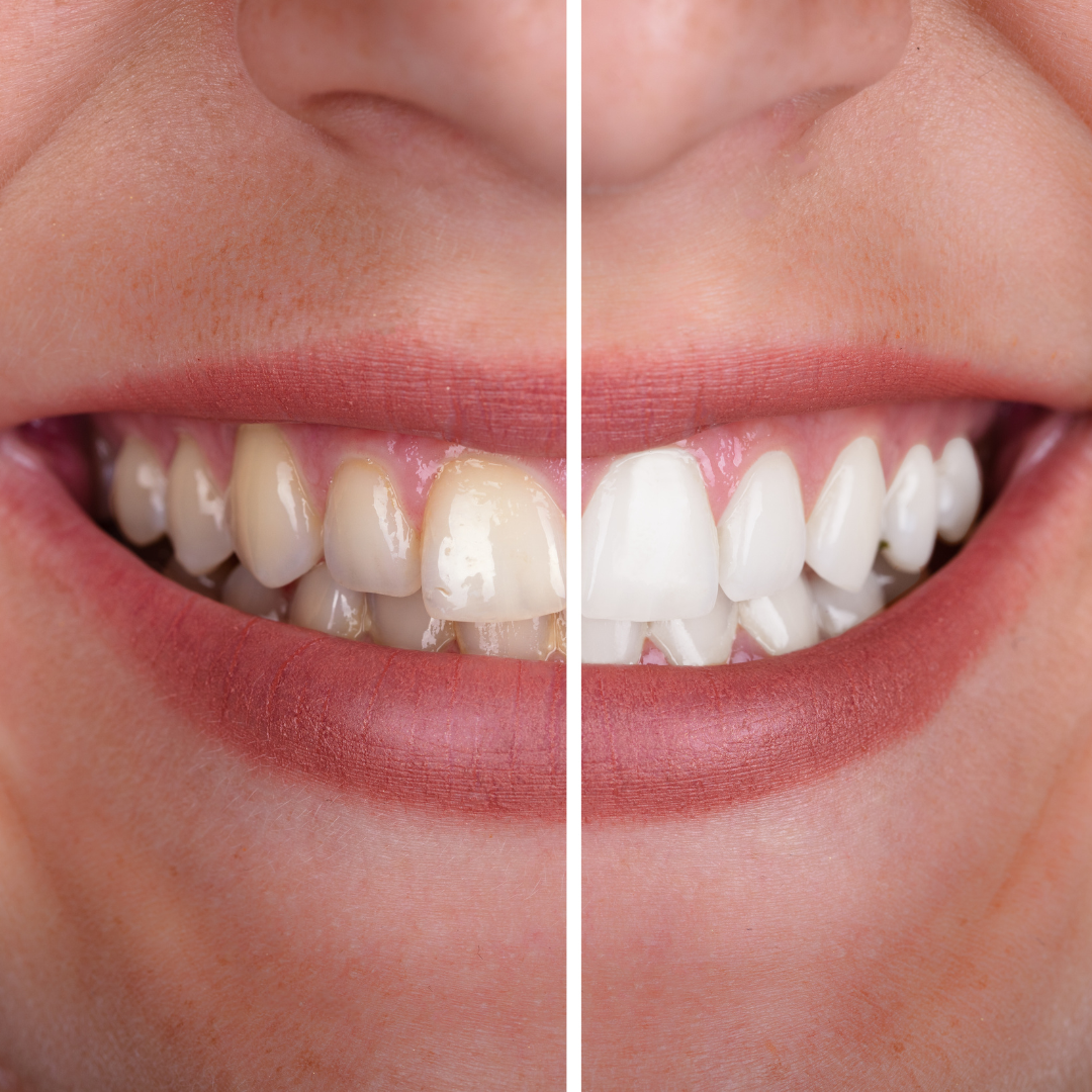 Laser Teeth Whitening Results