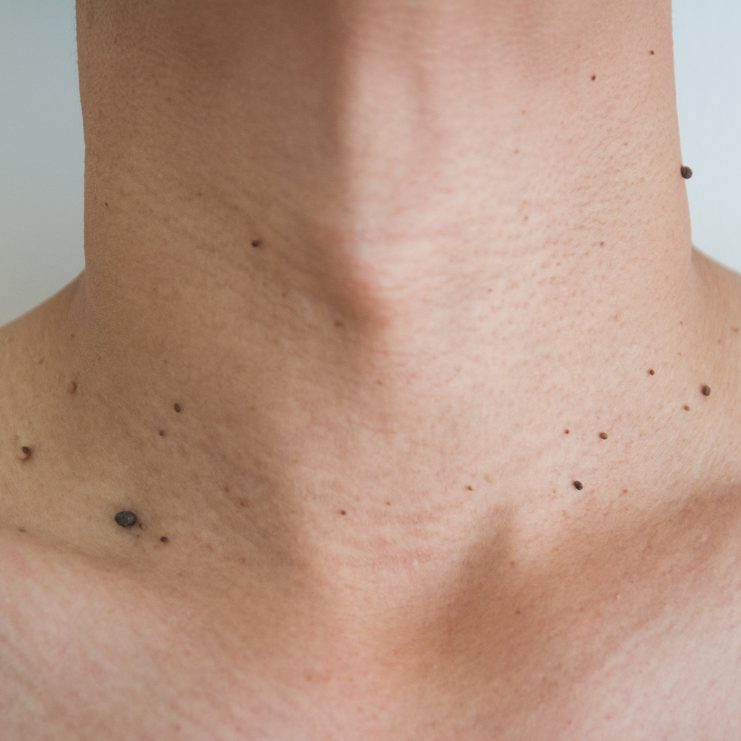 Skin Tag Removal