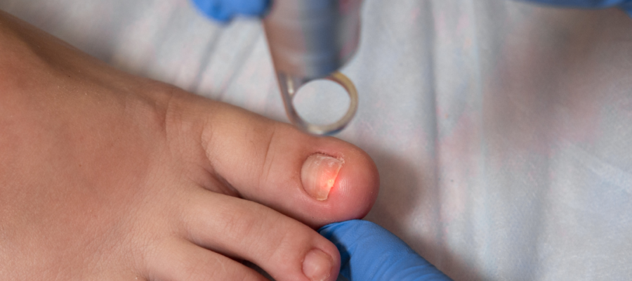 Home Remedies Work for Nail Fungus