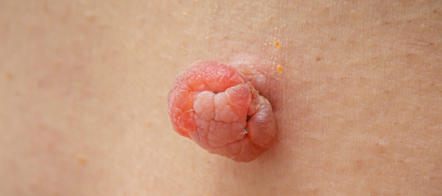 Prevent Skin Tags