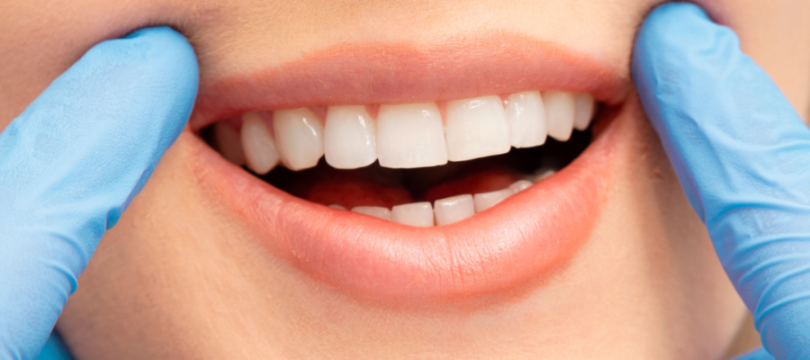 What to Avoid After a Teeth Whitening Treatment