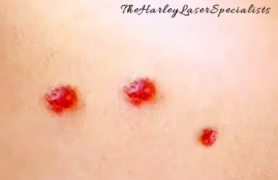 Cellulite: Causes And Effective Treatments for Smooth Skin